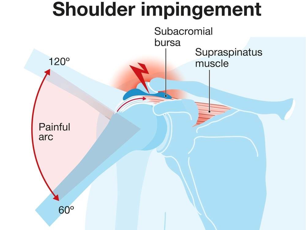 Shoulder Impingement Syndrome My Sports Chiropractor